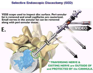 Epidural steroid injection pain